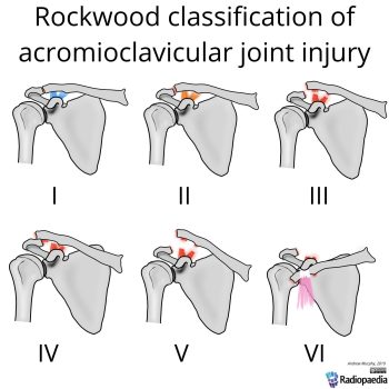 rockwood-classification-of-acromioclavicular-joint-injury